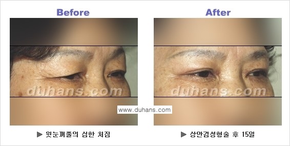 [두한성형외과 NO.1 눈성형] - [상안검 수술에 대한 정보] 관련 이미지 4