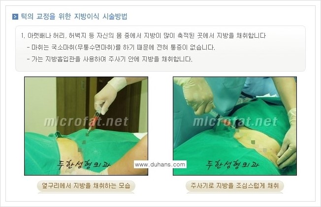 ⁠⁠[두한성형외과 경쟁력 미세지방이식] - [턱 미세지방이식 - 안면윤곽 교정 안내] 관련 이미지 7