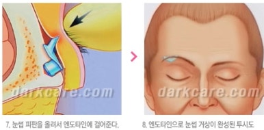 [눈밑수술 두한성형외과] - [다크서클 콤비프로그램] 관련 이미지 150