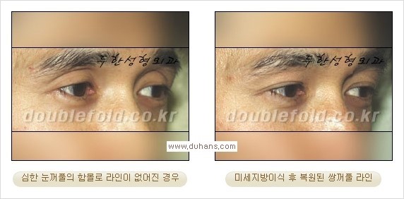 [두한성형외과 경쟁력 쌍꺼풀 재수술, 극한 눈재수술] - [미세지방이식으로 쌍꺼풀 라인의 복원에 관한 질문과 답변] 관련 이미지 1