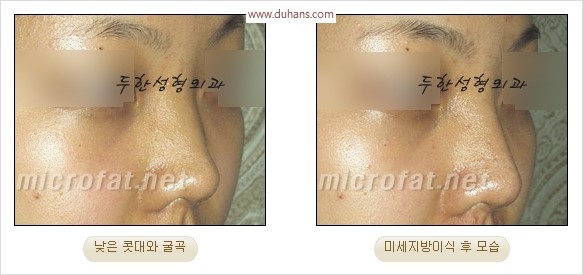 [두한성형외과 경쟁력 코성형 리더] - [자연스럽고 오똑한 콧망울! 코성형 방법]​ 관련 이미지 57