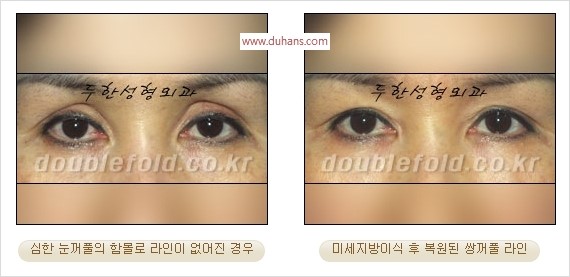 [두한성형외과 경쟁력 쌍꺼풀 재수술 리더] - [풀린 쌍꺼풀, 풀려버린 쌍꺼풀 재수술 방법 안내] 관련 이미지 6