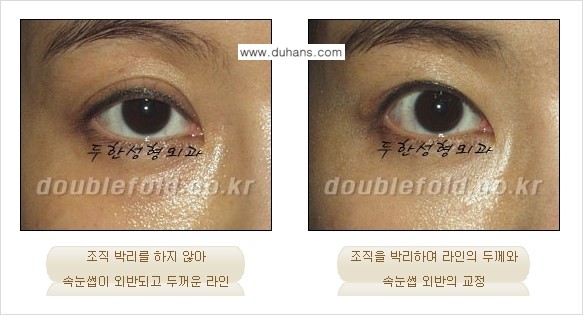 ​[두한성형외과] - [쌍꺼풀 재수술 클리닉의 특성과 자부심] 관련 이미지 3
