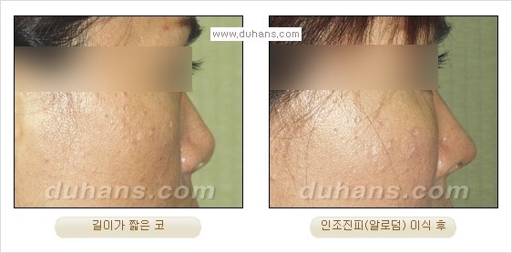 [두한성형외과 경쟁력 코성형] - [코성형을 위한 알로덤(슈어덤) 수술, 실리콘 수술 안내] 관련 이미지 16