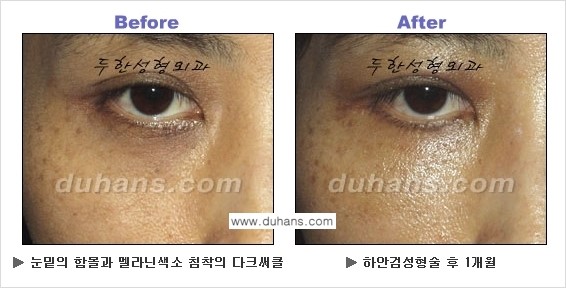 [두한성형외과의 상큼하고 환한 젊은 눈매완성] - [하안검 성형술 ②] 관련 이미지 8