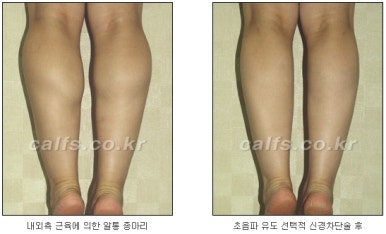 ​[두한성형외과 종아리수술] - [나에게 맞는 종아리성형방법] 관련 이미지 18