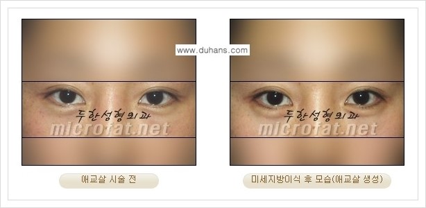 [두한성형외과 경쟁력 눈밑성형] - [눈밑 애교살 시술 안내 1.] 관련 이미지 4