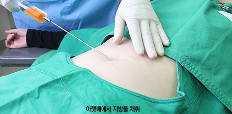 [두한성형외과 다크서클] - [콜펫지방이식] 관련 이미지 6