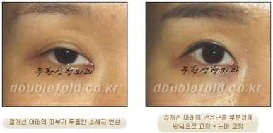 [두한성형외과 쌍커풀재수술] - [심한 소세지눈, 두줄따기, 쌍꺼풀 흉터] 관련 이미지 34