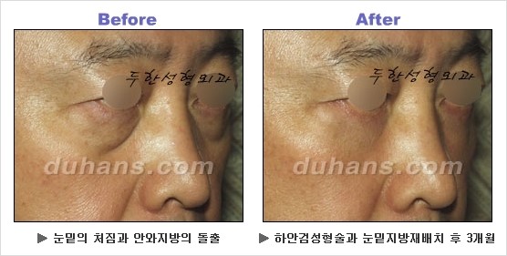 [두한성형외과 경쟁력 동안성형 리더] - ​[미간주름, 이마주름, 안검성형, 이마거상술, 눈썹거상술] 관련 이미지 95