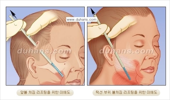 [두한성형외과 젊어지는 주름교정술] - [주름제거 시술방법 ②] 관련 이미지 6