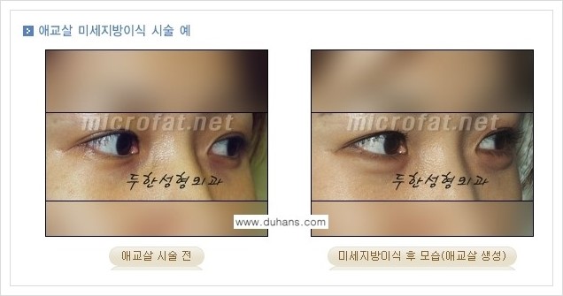 [두한성형외과 경쟁력 눈밑성형] - [애교살과 다크써클과의 관계] 관련 이미지 5