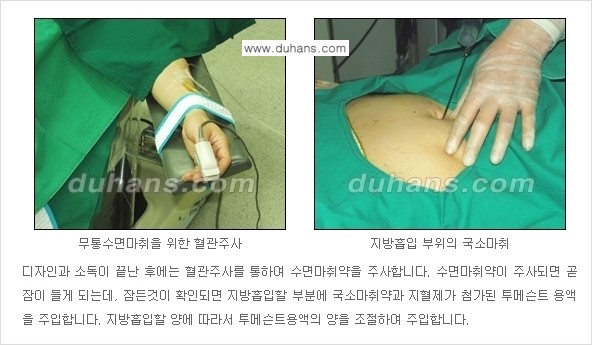 [두한성형외과 경쟁력 간편지방흡입] - [복부(뱃살) 비만 간편지방흡입] 관련 이미지 9
