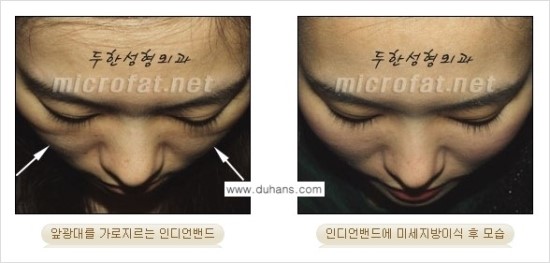 [두한성형외과 경쟁력 귀족성형] - [3차원 입체 미세지방이식 귀족수술 + 인디언밴드 교정] 관련 이미지 22