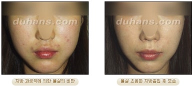 [두한성형외과 안전한 지방흡입] - [얼굴지방흡입] 관련 이미지 35