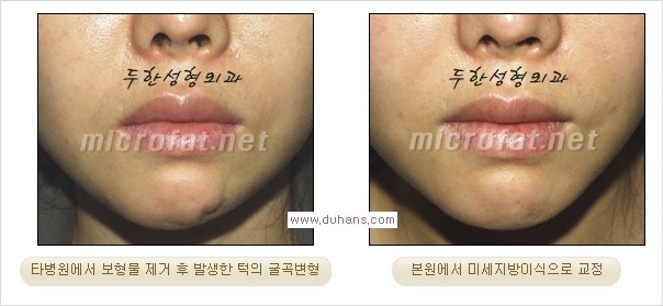 ⁠⁠[두한성형외과 경쟁력 미세지방이식] - [턱 미세지방이식 - 안면윤곽 교정 안내] 관련 이미지 11
