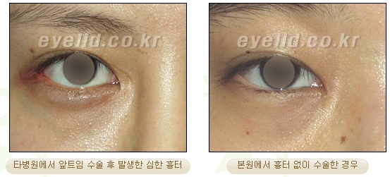 두한성형외과 몽고주름 제거 관련 이미지 4