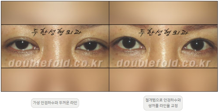[Ptosis, Duhan Plastic Surgery] - [Sleepy-Looking Eyes, Ptosis Eye Correction] image 19