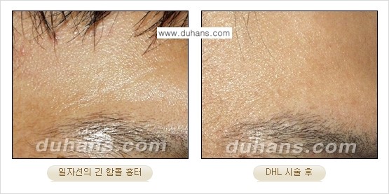 [두한성형외과 함몰 흉터 교정] - [동시에 3가지 시술로 효과적인 흉터의 교정 안내 ②] 관련 이미지 10