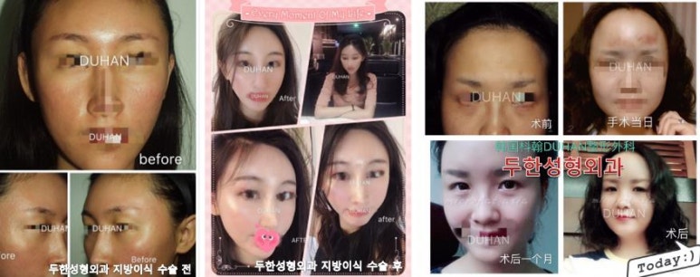 얼굴지방이식 두한성형외과 - 볼지방이식 관련 이미지 53