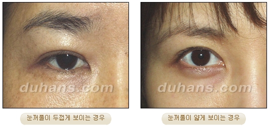 [DuHan Plastic Surgery Eye Surgery] - [Double Eyelid Surgery Guide] image 13