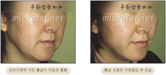 [Duhan Plastic Surgery Liposuction] - [Facial Liposuction] image 33