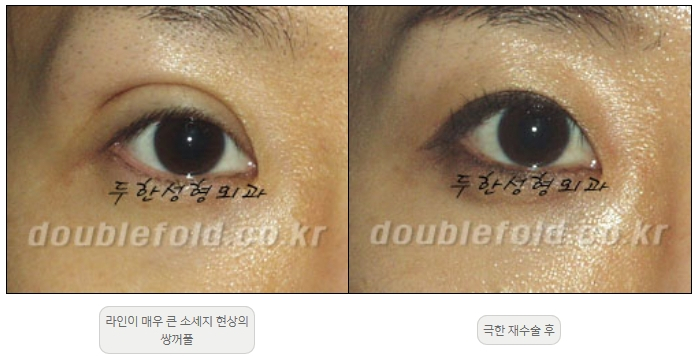 [Double Eyelid Surgery, Duhan Plastic Surgery] - [Extreme Revision Eye Surgery to Correct a Damaged Line] image 22