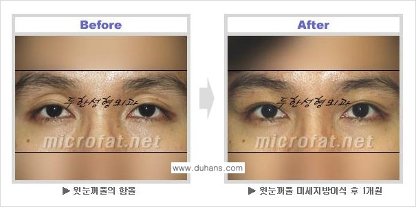 [두한성형외과 NO.1 눈성형] - [눈꺼풀 지방이식 관련 흔한 질문과 답변] 관련 이미지 2