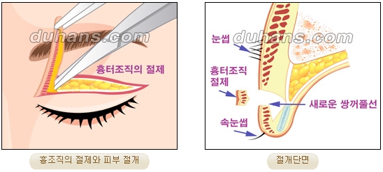눈성형잘하는곳 두한성형외과 - 겹쌍꺼풀 관련 이미지 16