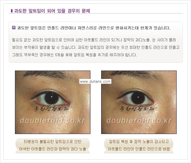 [두한성형외과 경쟁력 쌍꺼풀 재수술, 극한 재수술] - [재수술에서 극복해야 할 극한의 상황과 문제들 안내] 관련 이미지 5