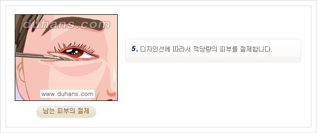 [두한성형외과 경쟁력 안검성형] - [젊은 눈매 하안검 성형술 안내] 관련 이미지 7