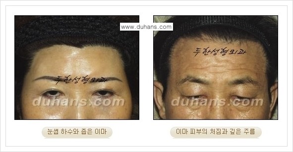 [두한성형외과 경쟁력 주름성형] - [엔도타인 리프팅 안내 ①] 관련 이미지 1
