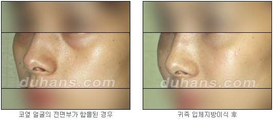 [두한성형외과 얼굴자가지방이식] - [귀족수술 입체 미세지방이식] 관련 이미지 13