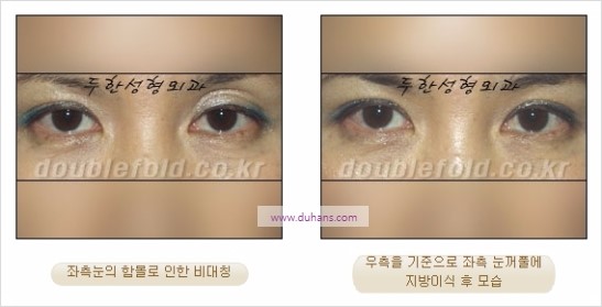 [두한성형외과 경쟁력 눈성형] - [비대칭 쌍꺼풀 라인의 여러 가지 교정 방법] 관련 이미지 17