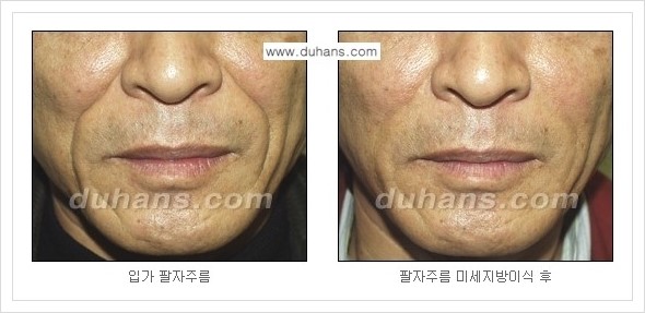[두한성형외과 경쟁력 주름성형] - [코 옆과 입가에 걸쳐서 형성된 주름을 교정해주는 미세지방이식] 관련 이미지 19