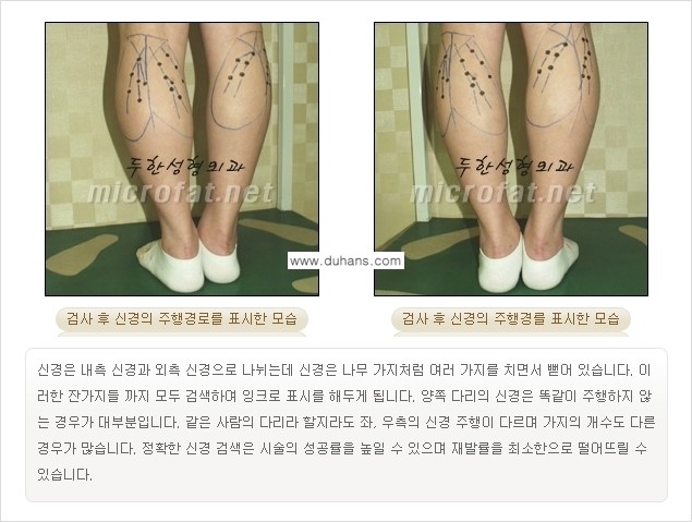 [두한성형외과 경쟁력 멀티종아리성형] - [초음파 유도 비절개 선택적 신경차단술의 효과] 관련 이미지 10
