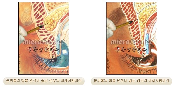 [Doohan Plastic Surgery Autologous Fat Grafting] - [Sunken Eye Fat Grafting] image 4
