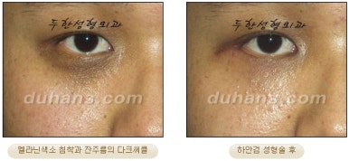 Blepharoplasty, Duhan Plastic Surgery - Upper and Lower Eyelids image 42