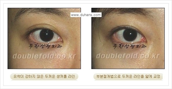 [두한성형외과 경쟁력 눈성형] - [부분절개법으로 두껍고 어색한 라인 교정 안내 2.] 관련 이미지 5