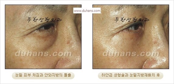 [두한성형외과 경쟁력 안검성형] - [눈밑주름 제거수술] 관련 이미지 27