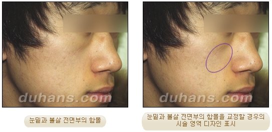 [두한성형외과 얼굴자가지방이식] - [귀족수술 입체 미세지방이식] 관련 이미지 5