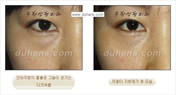 [두한성형외과 젊은 눈매 안검성형] - [눈밑 지방제거의 수술 전후 안내 ①] 관련 이미지 14