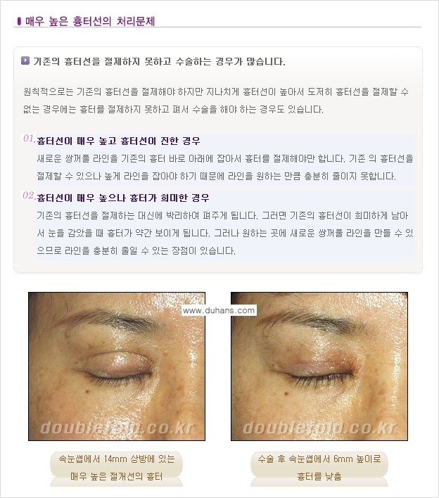 [두한성형외과 극한 재수술, 쌍꺼풀 재수술] - [쌍꺼풀 재수술에서 극복해야 할 극한의 상황과 문제] 관련 이미지 2