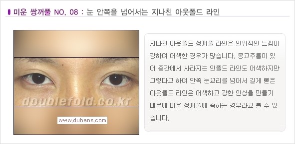 [두한성형외과 경쟁력 눈성형] - [나에게 맞는 맞춤 쌍꺼풀 찾기] 관련 이미지 8