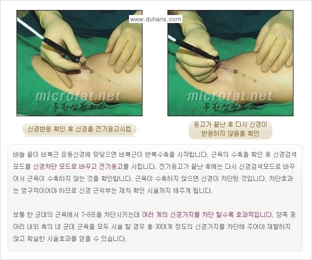 [두한성형외과 경쟁력 멀티종아리성형] - [초음파 유도 비절개 선택적 신경차단술의 효과] 관련 이미지 15