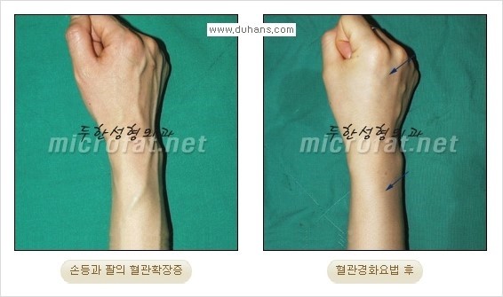 [두한성형외과 경쟁력 정맥류 치료] - [손, 손등, 손목혈관확장증, 팔혈관확장증에 질문과 답변] 관련 이미지 12