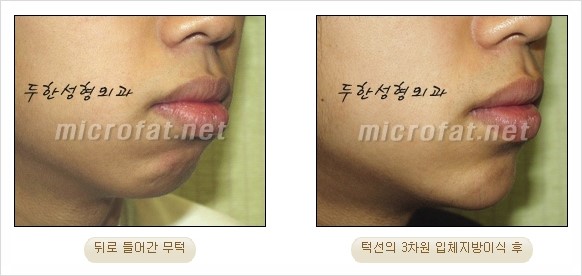 [두한성형외과 경쟁력 지방이식 리더] - [Col-fat(콜펫)지방이식, 3차원 입체지방이식, 2차원 평면지방이식] 관련 이미지 39