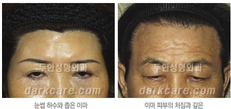 Duhan Plastic Surgery Combo Program - Dark Circles and Lifting image 2