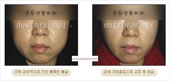 [두한성형외과 경쟁력 윤곽성형] - [볼, 볼살 지방이식] 관련 이미지 39