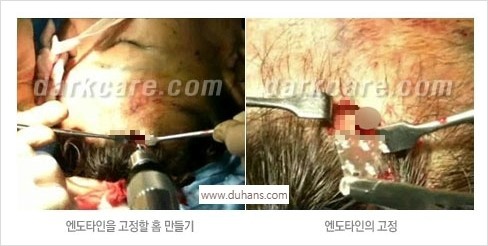 [두한성형외과 경쟁력 Quick 주름성형] - [주름제거, 탄력증대! 리프팅 시리즈 안내] 관련 이미지 22